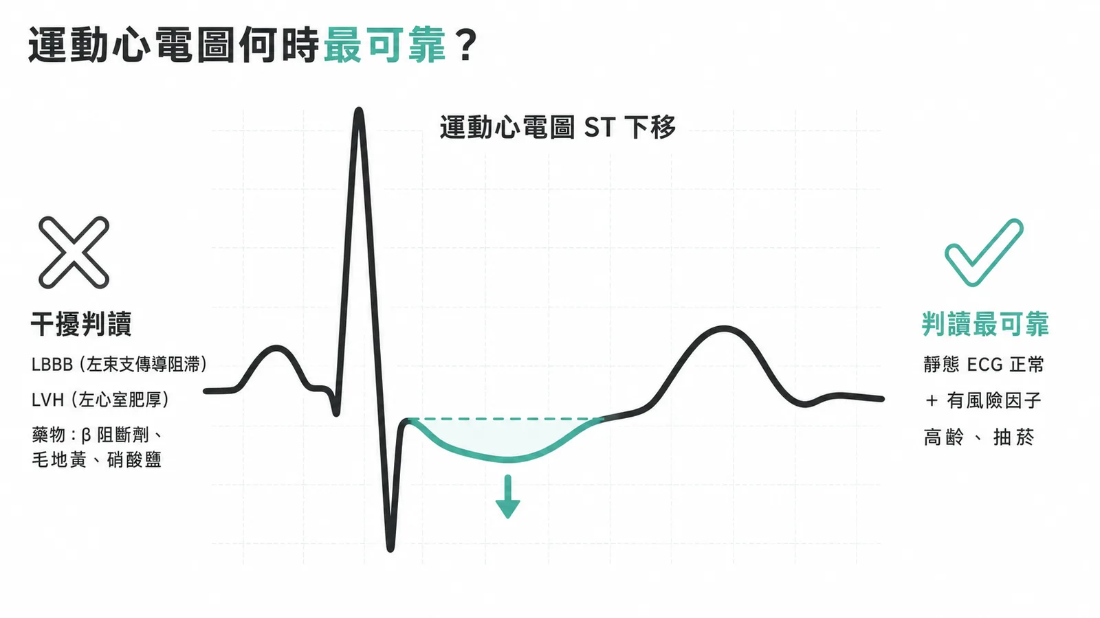 運動心電圖判讀可靠度:LBBB、LVH、藥物會干擾,靜態 ECG 正常且有風險因子時最可靠
