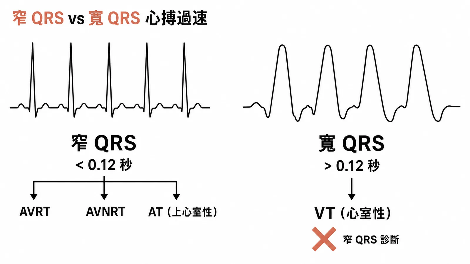 窄 QRS 與寬 QRS 心搏過速鑑別:窄 QRS 為上心室性(AVRT、AVNRT、AT),VT 為寬 QRS 不可能是窄 QRS 診斷