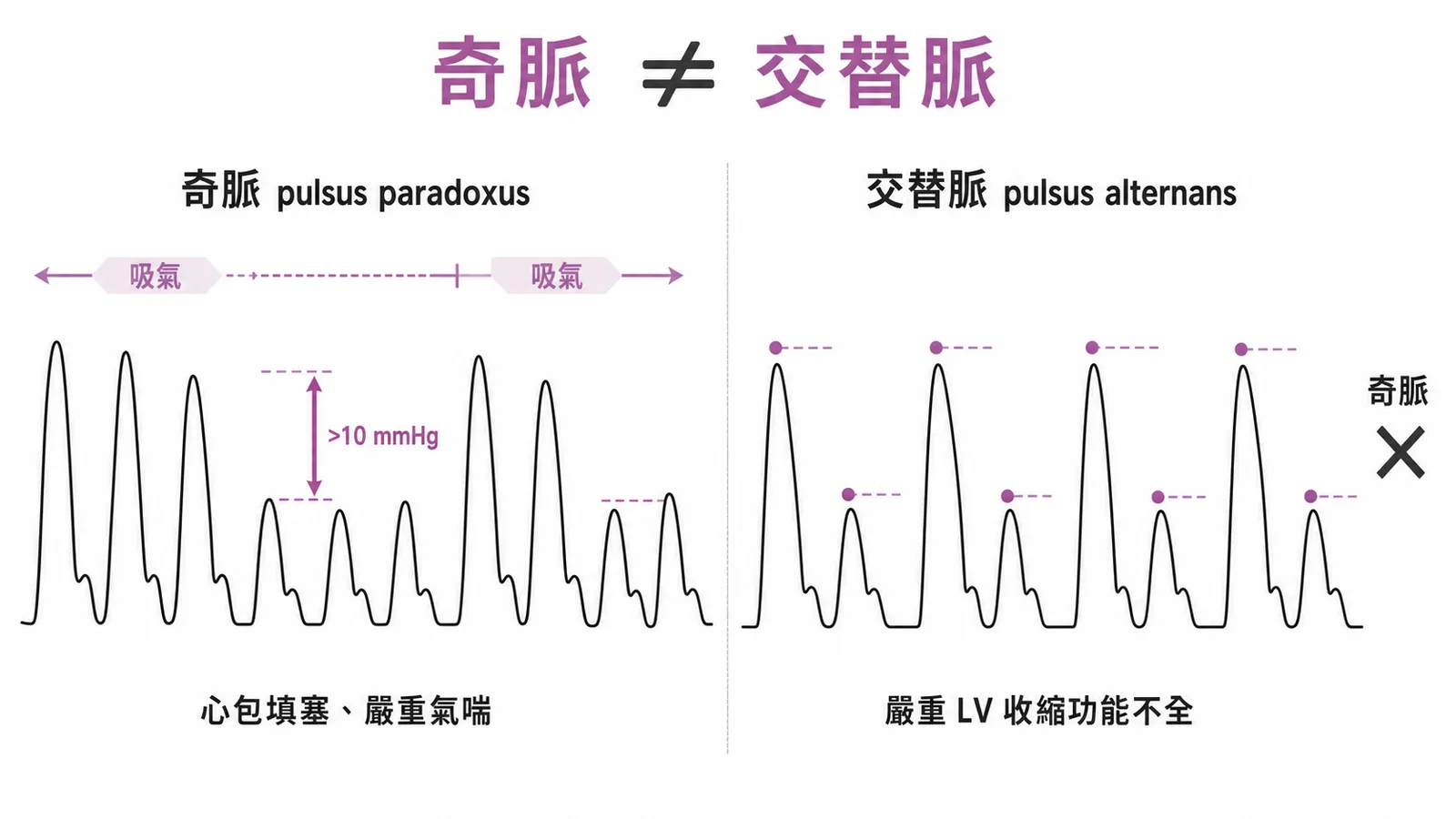 奇脈與交替脈的脈搏波形鑑別對照