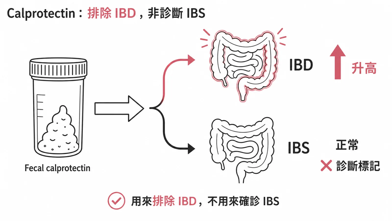 Fecal calprotectin用於排除IBD而非診斷IBS
