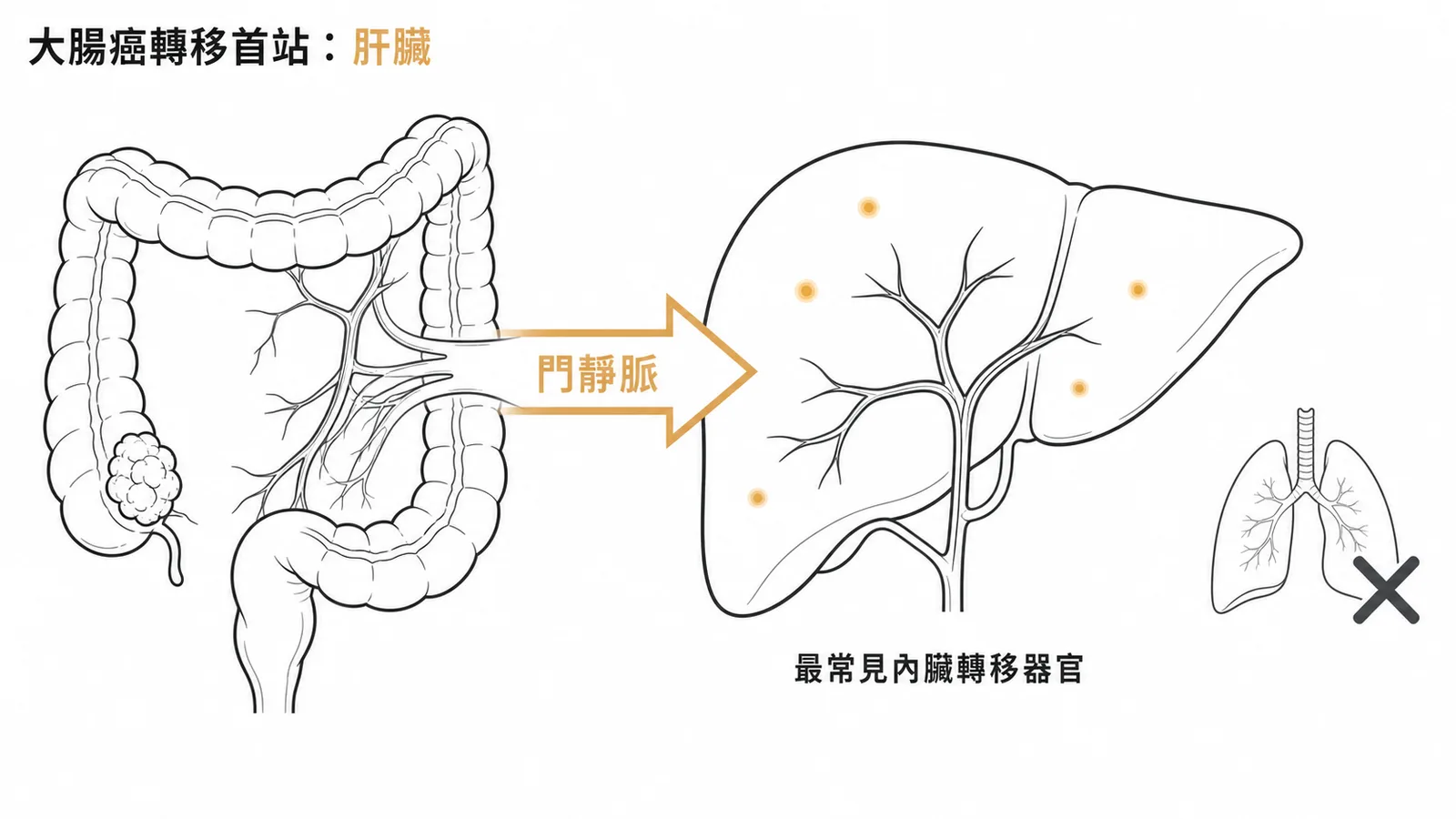 大腸癌經門靜脈轉移至肝臟示意