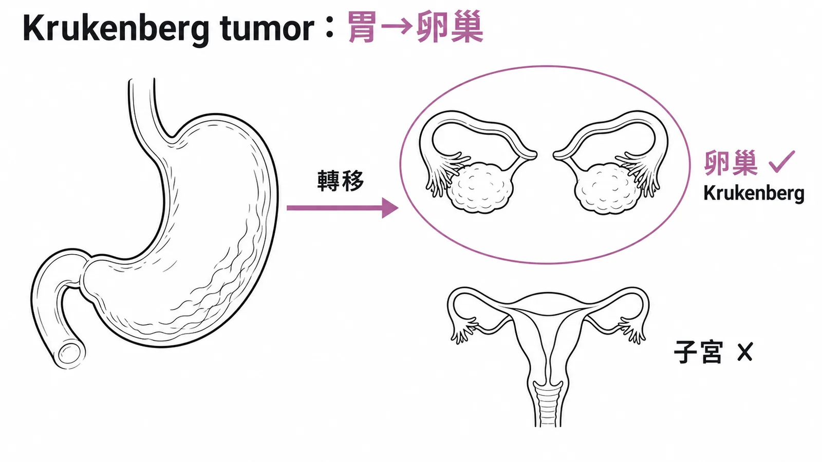 Krukenberg tumor是胃癌轉移至卵巢非子宮
