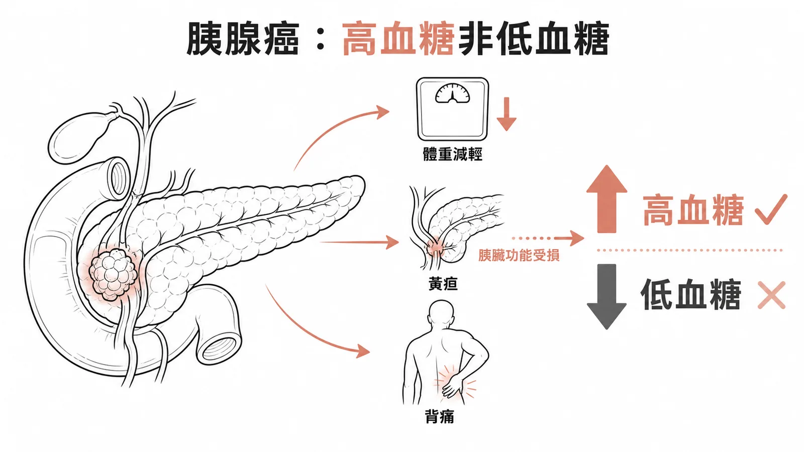 胰腺癌常見症狀與高血糖非低血糖