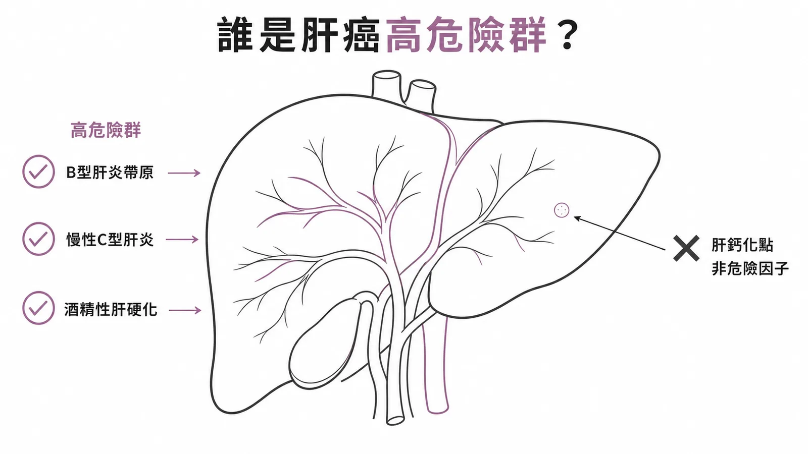 肝細胞癌高危險群與良性發現對照圖:B型肝炎帶原、慢性C型肝炎、酒精性肝硬化為高危險群,肝鈣化點非危險因子