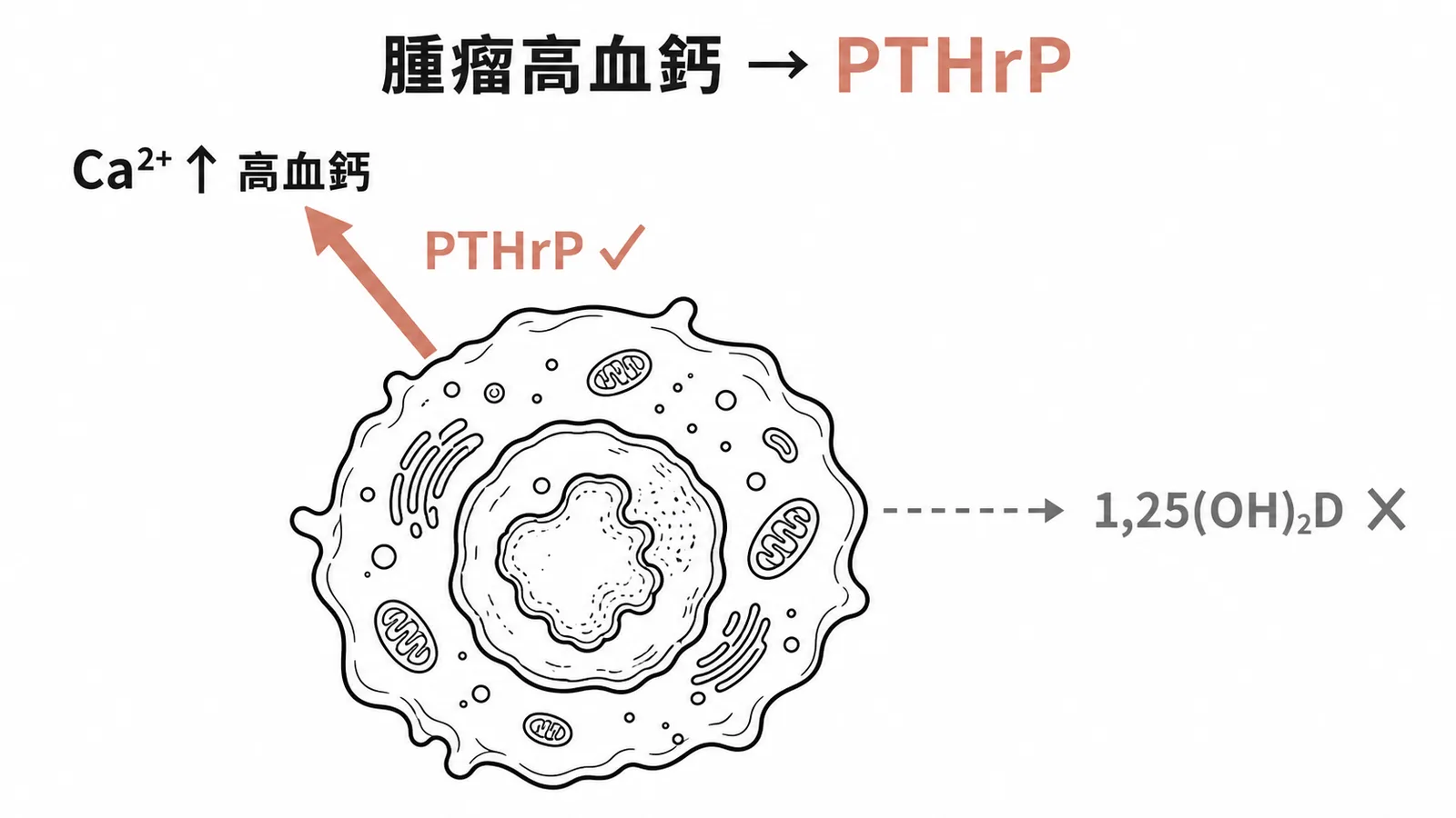 惡性腫瘤高血鈣最常見原因為 PTHrP,非 1,25(OH)₂D