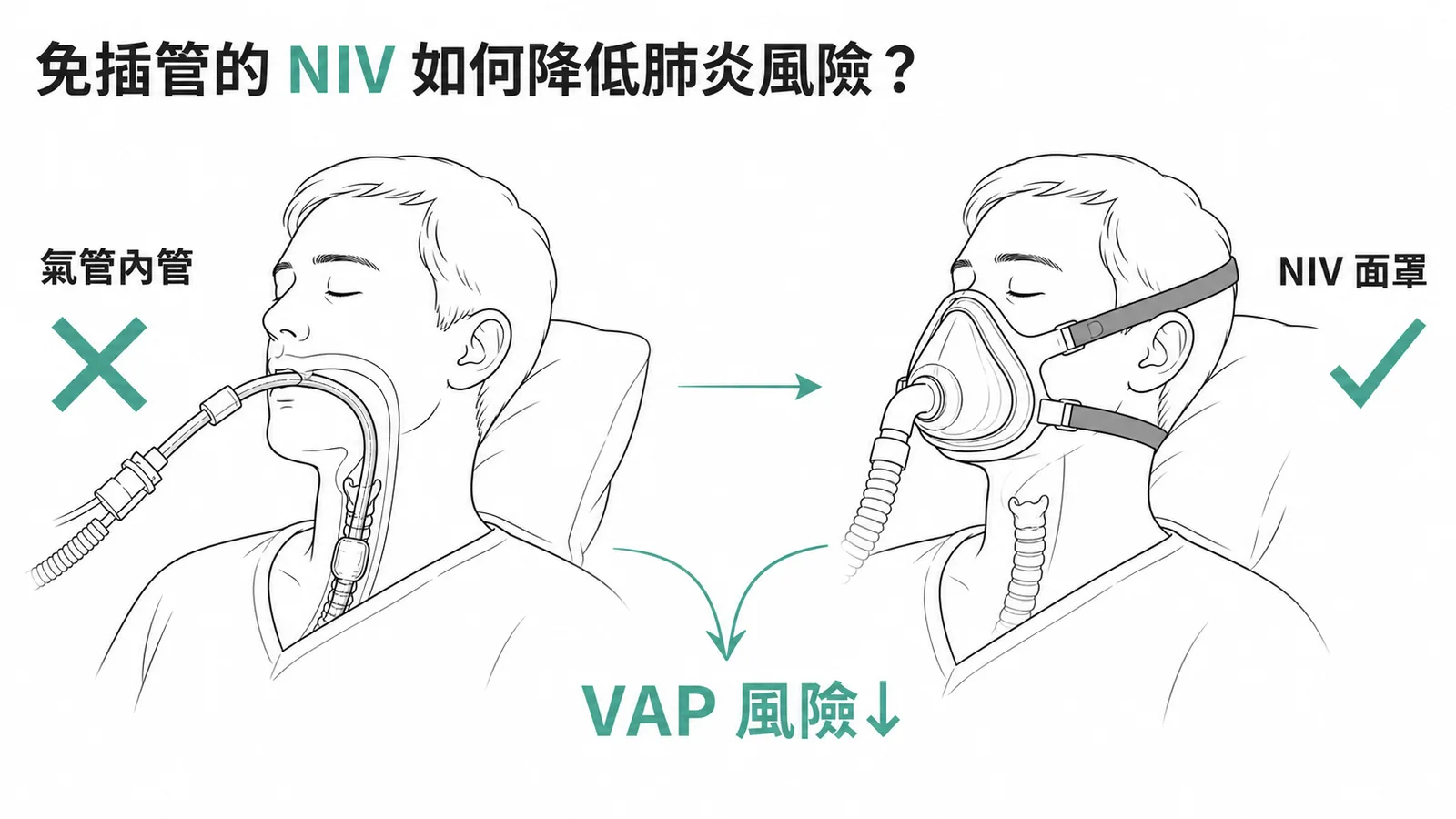非侵襲性正壓通氣NIV用面罩免插管,大幅降低呼吸器相關肺炎VAP風險