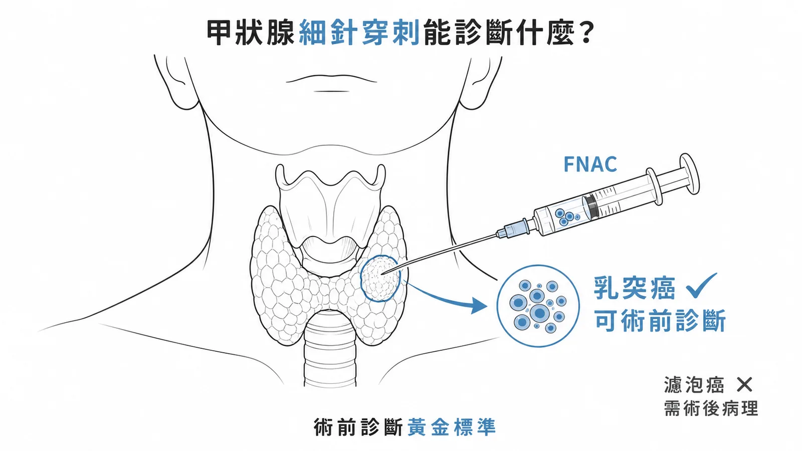 甲狀腺細針穿刺(FNAC)可術前診斷乳突癌,但無法區分濾泡腺瘤與濾泡癌