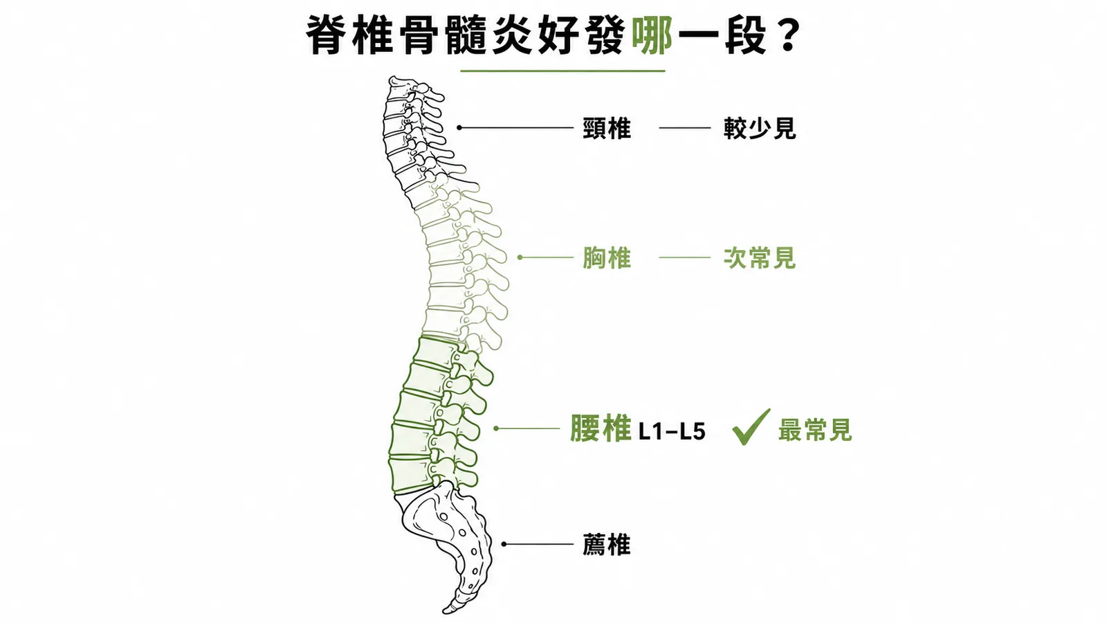 脊椎骨髓炎好發部位示意圖:腰椎最常見、胸椎次之、頸椎較少