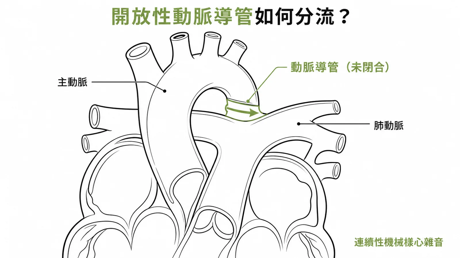 開放性動脈導管分流示意圖:主動脈弓經未閉合的動脈導管向肺動脈分流,產生連續性機械樣心雜音