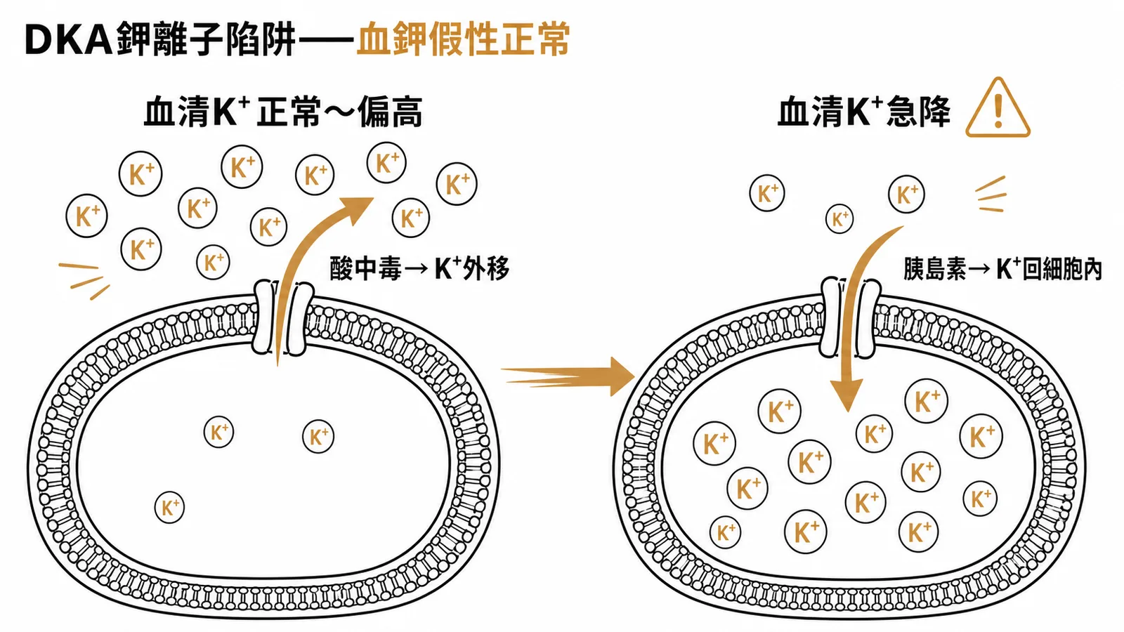 DKA鉀離子陷阱示意圖:酸中毒時K⁺外移致血清鉀假性正常,胰島素治療後K⁺回細胞內導致血鉀急降