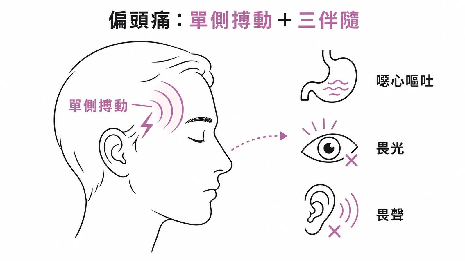 偏頭痛典型特徵:單側搏動性頭痛伴噁心、畏光、畏聲