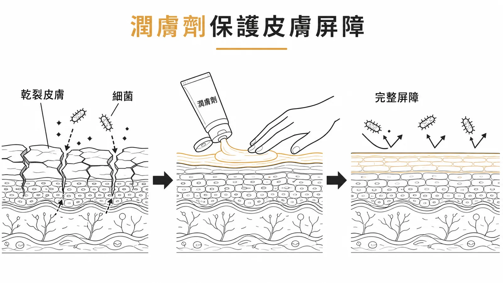 淋巴水腫皮膚塗潤膚劑修復屏障降低感染風險