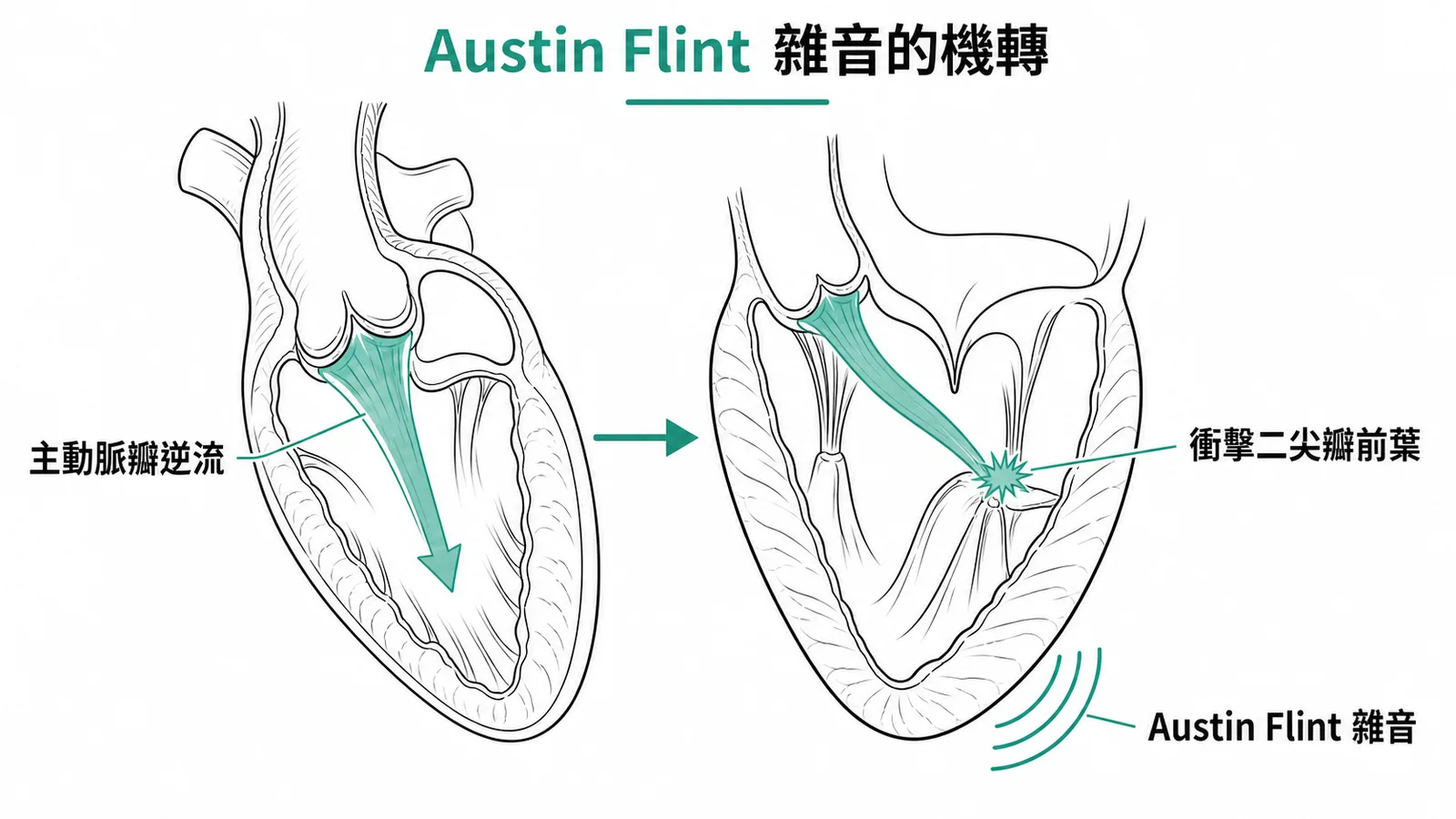 Austin Flint雜音機轉:主動脈回流衝擊二尖瓣前葉