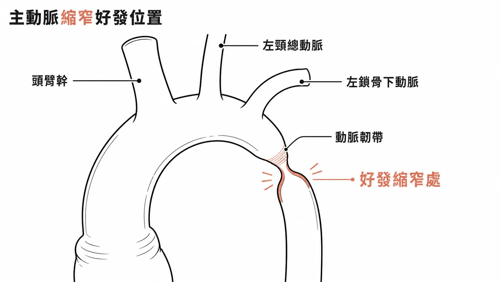 主動脈縮窄好發位置:左鎖骨下動脈遠端