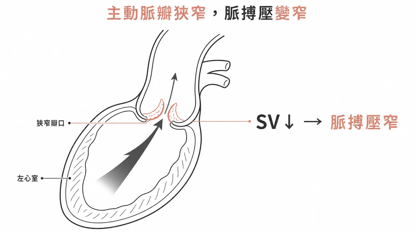 主動脈瓣狹窄使心搏量減少導致脈搏壓變窄