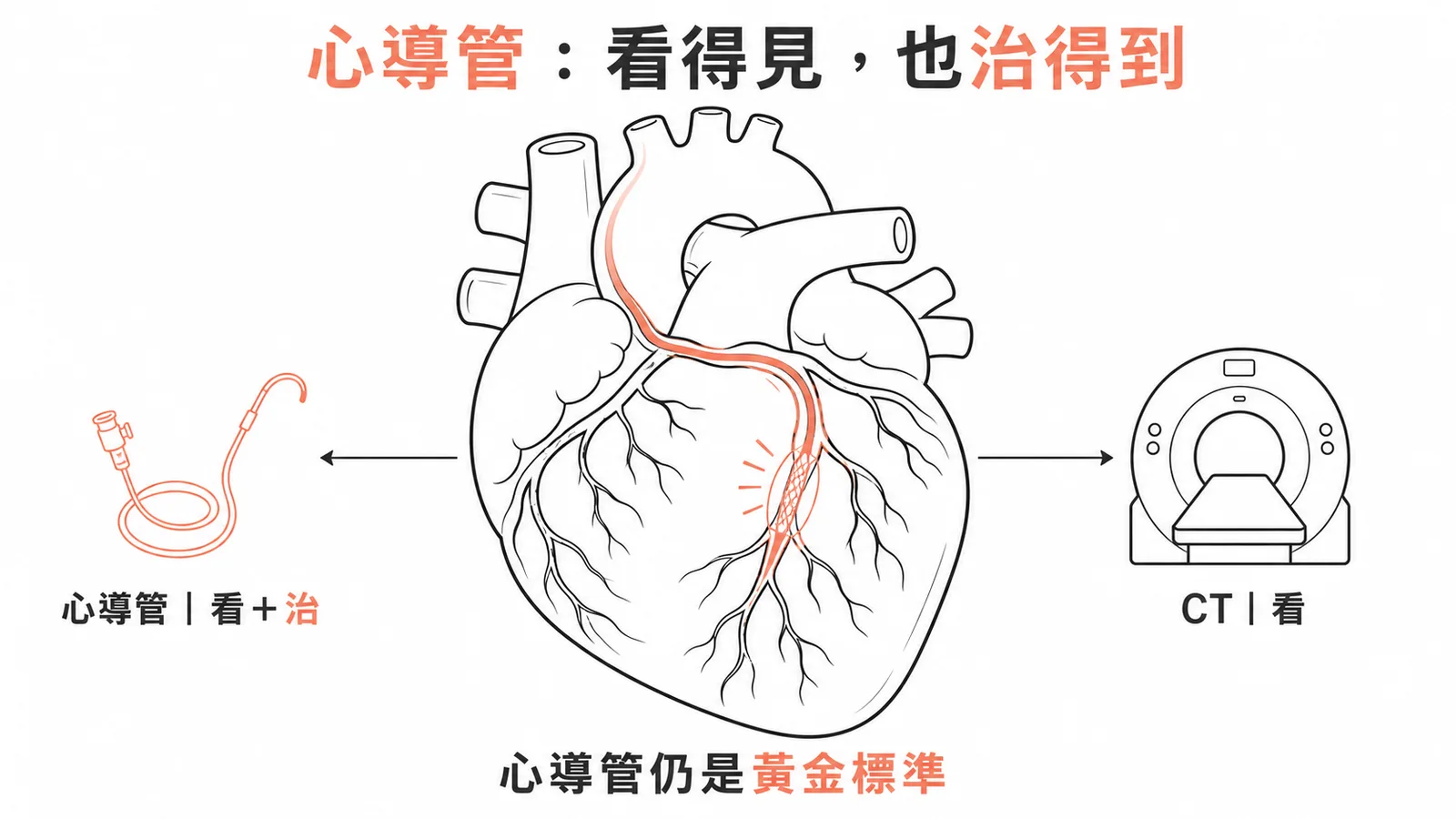 心導管診斷加治療仍是冠脈黃金標準