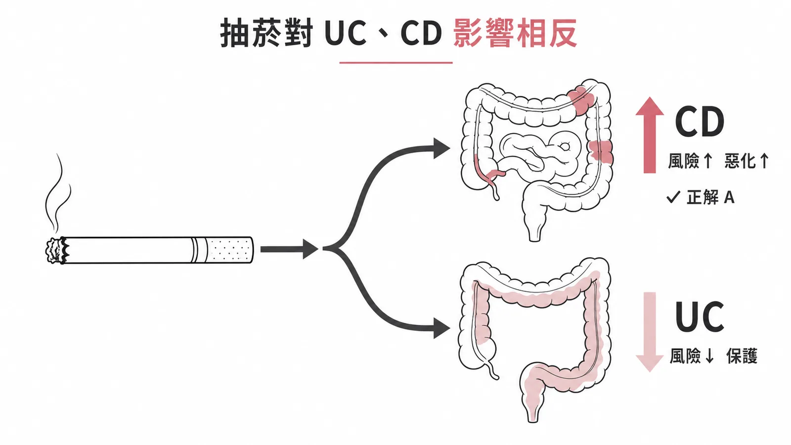 抽菸對 UC 與 CD 的影響相反:CD 風險增加、UC 反而受保護