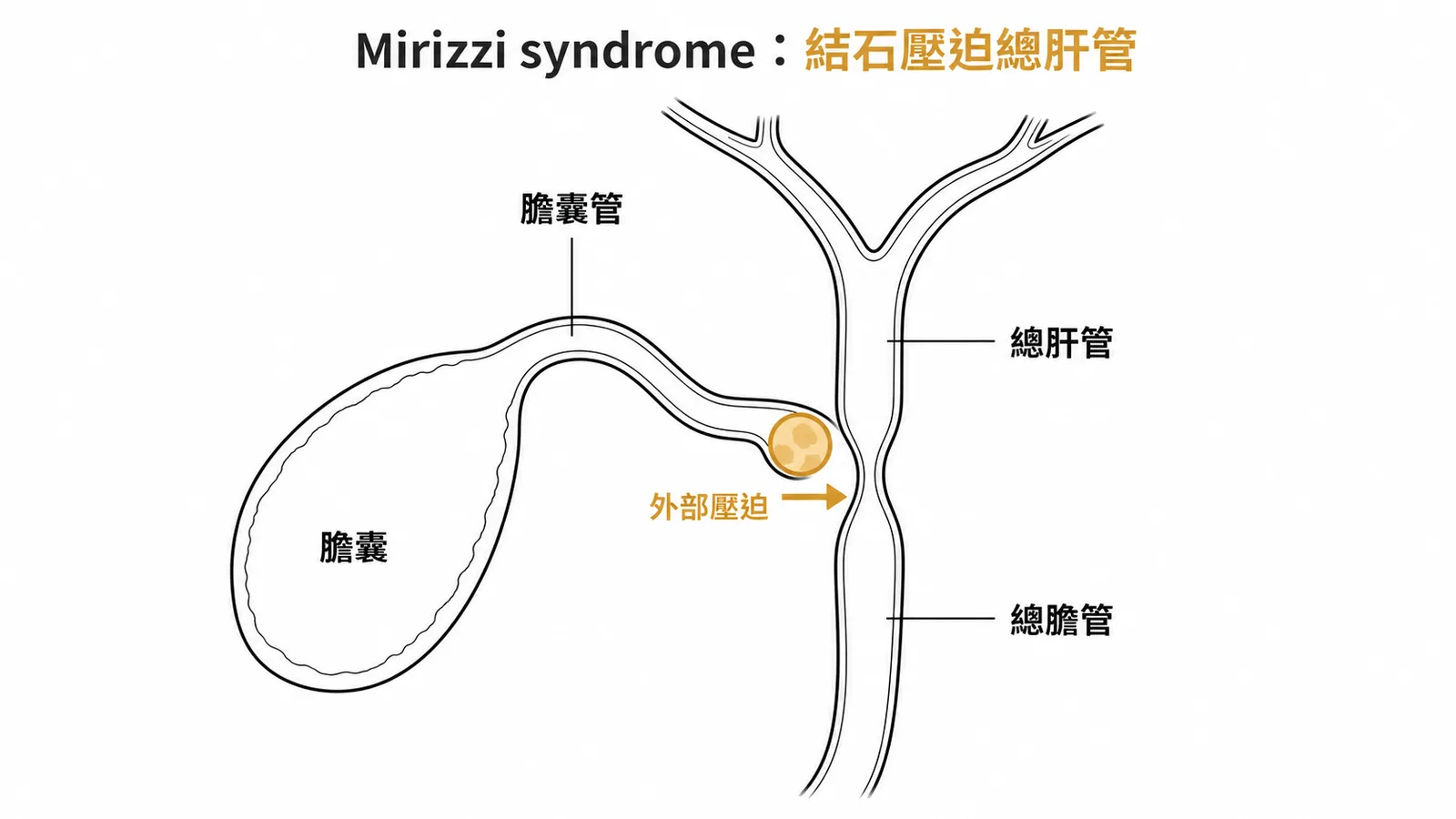 Mirizzi syndrome:膽囊管結石壓迫總肝管造成阻塞性黃疸