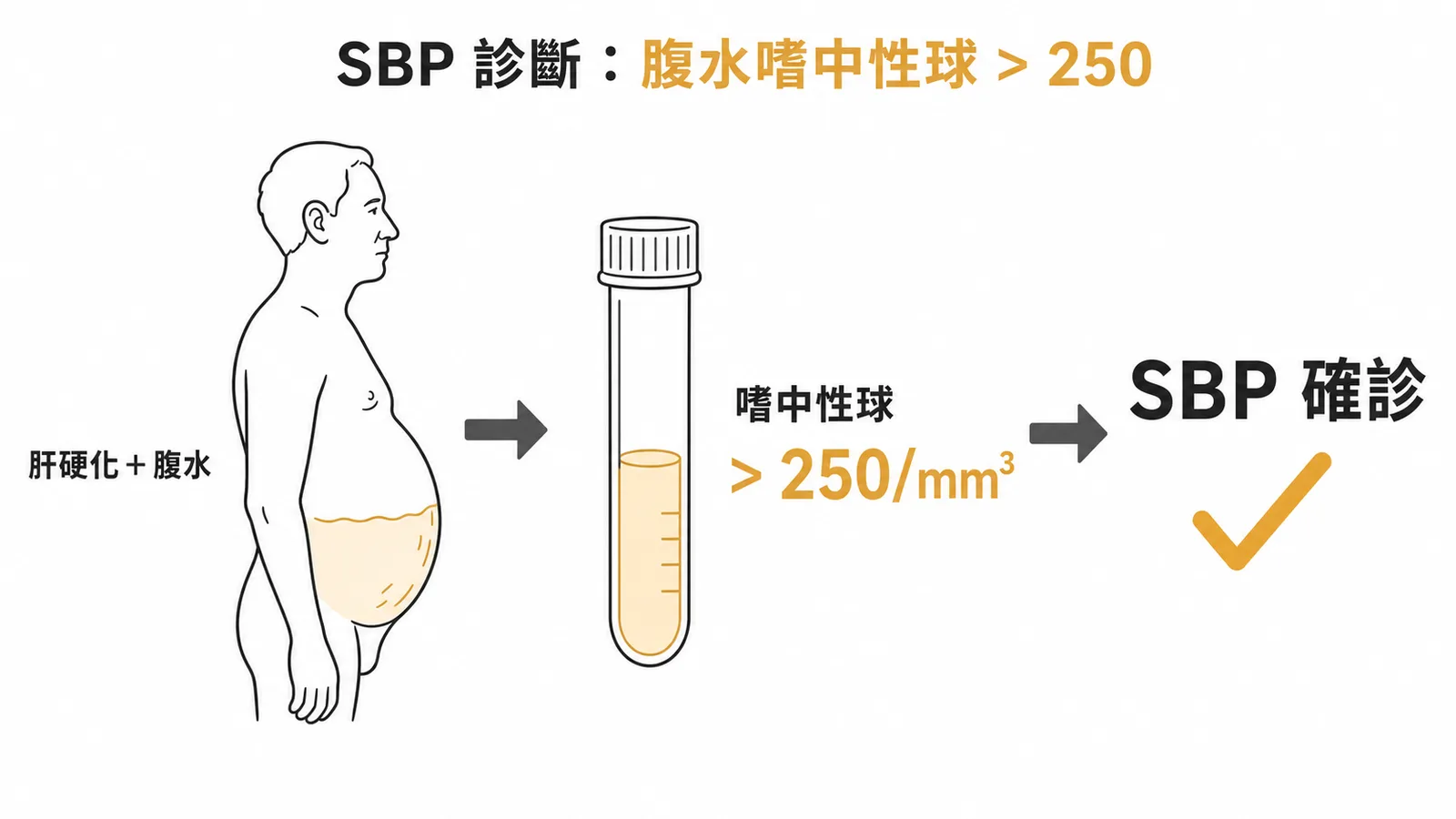 SBP 診斷流程:肝硬化腹水→腹水嗜中性球 > 250/mm³→確診自發性細菌性腹膜炎