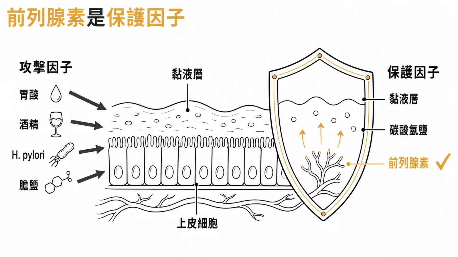 胃黏膜攻擊因子(胃酸、酒精、H. pylori、膽鹽)vs 保護因子(黏液層、碳酸氫鹽、前列腺素)