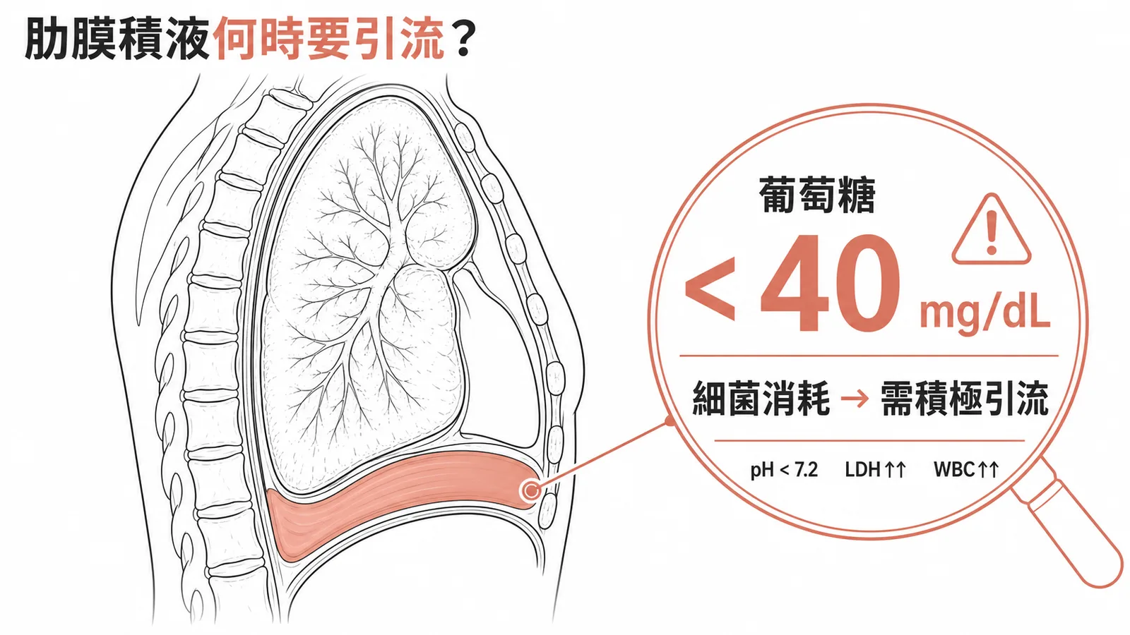 肋膜積液何時要引流:葡萄糖低於40代表細菌消耗需積極引流