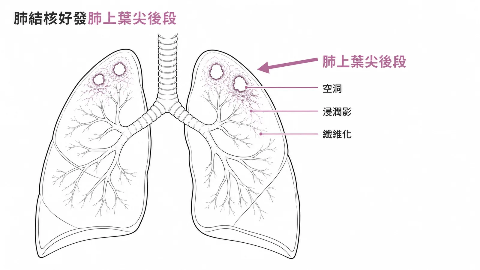 肺結核好發肺上葉尖後段——空洞、浸潤影與纖維化示意圖
