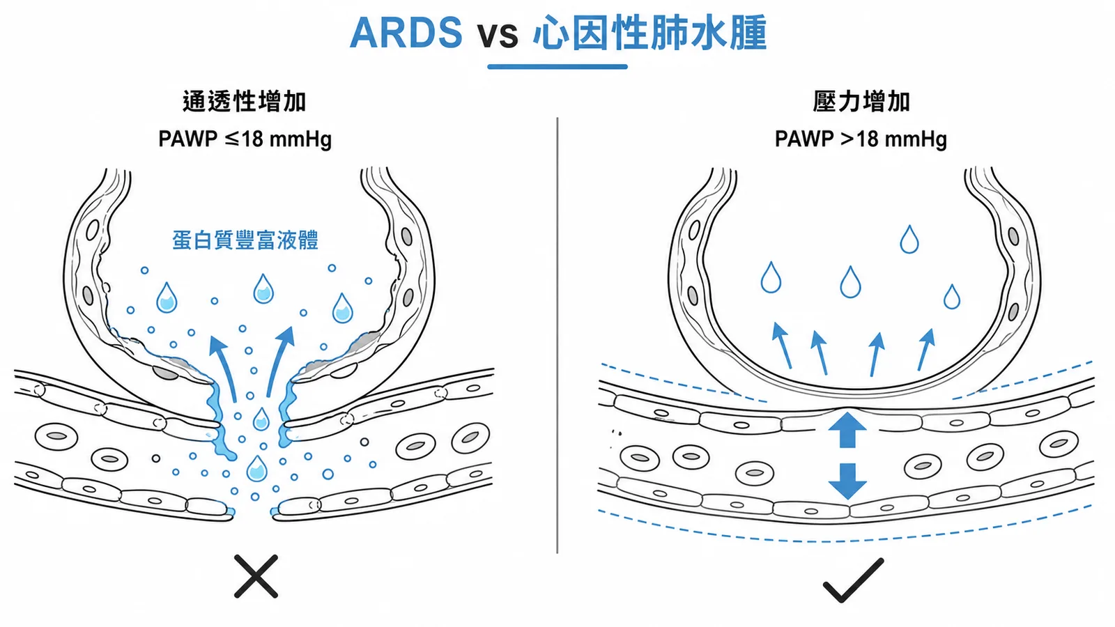 ARDS與心因性肺水腫的根本差異——通透性增加vs壓力增加