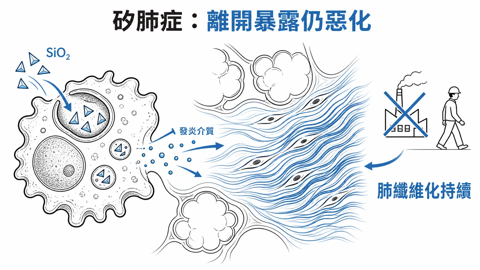 矽肺症——離開暴露源後肺纖維化仍持續惡化