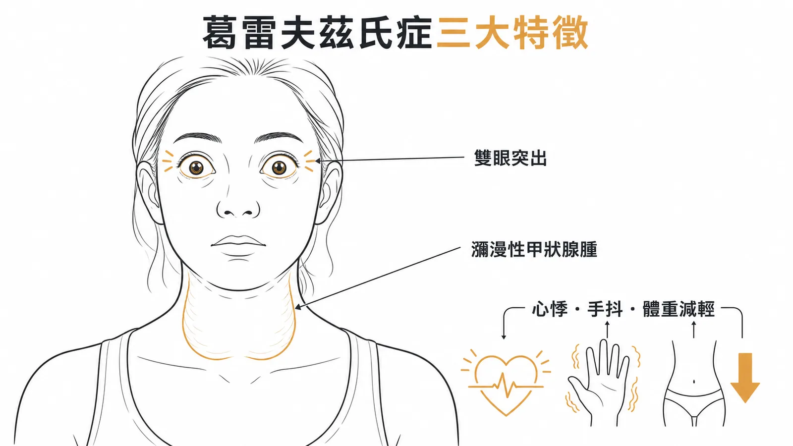 葛雷夫茲氏症三大特徵:雙眼突出、瀰漫性甲狀腺腫、甲亢症狀