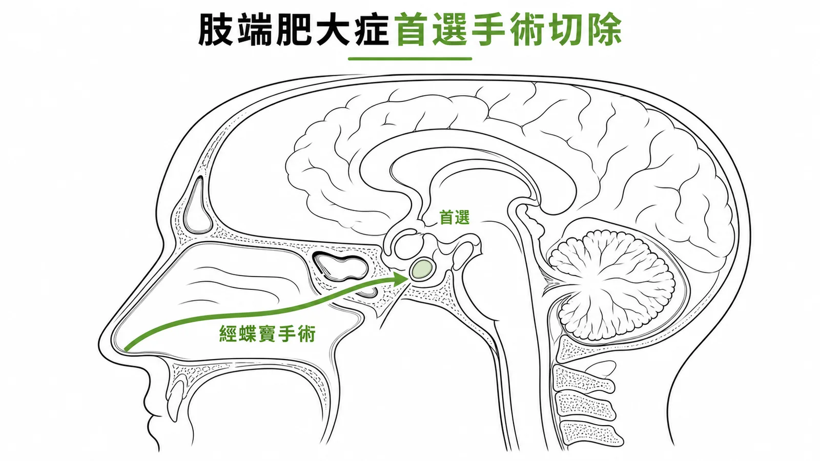 肢端肥大症首選經蝶竇手術切除腦下垂體腫瘤