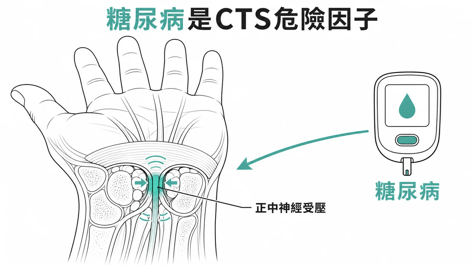 糖尿病是腕隧道症候群的全身性危險因子