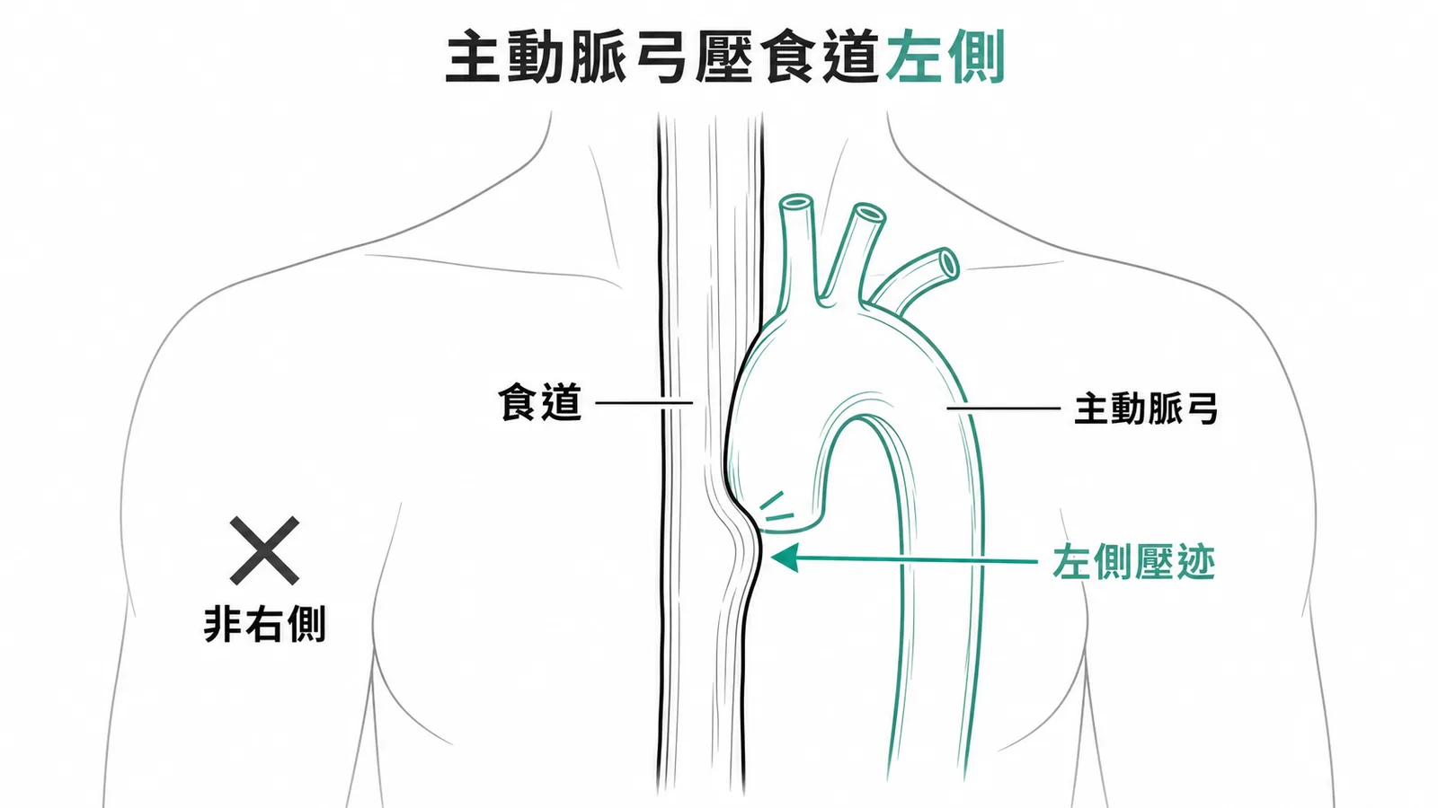 主動脈弓位於食道左側形成壓迹