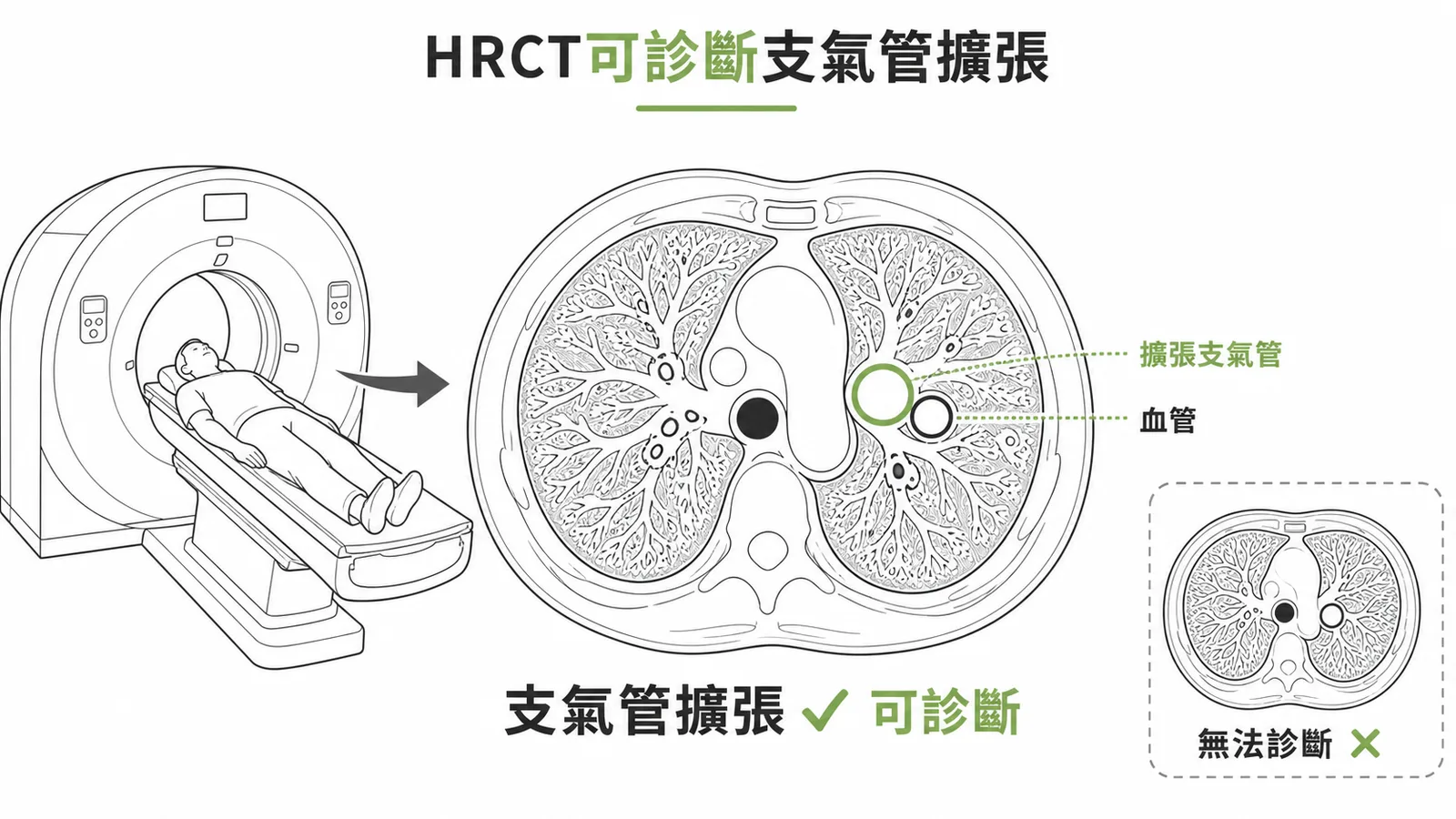 HRCT是診斷支氣管擴張的黃金標準
