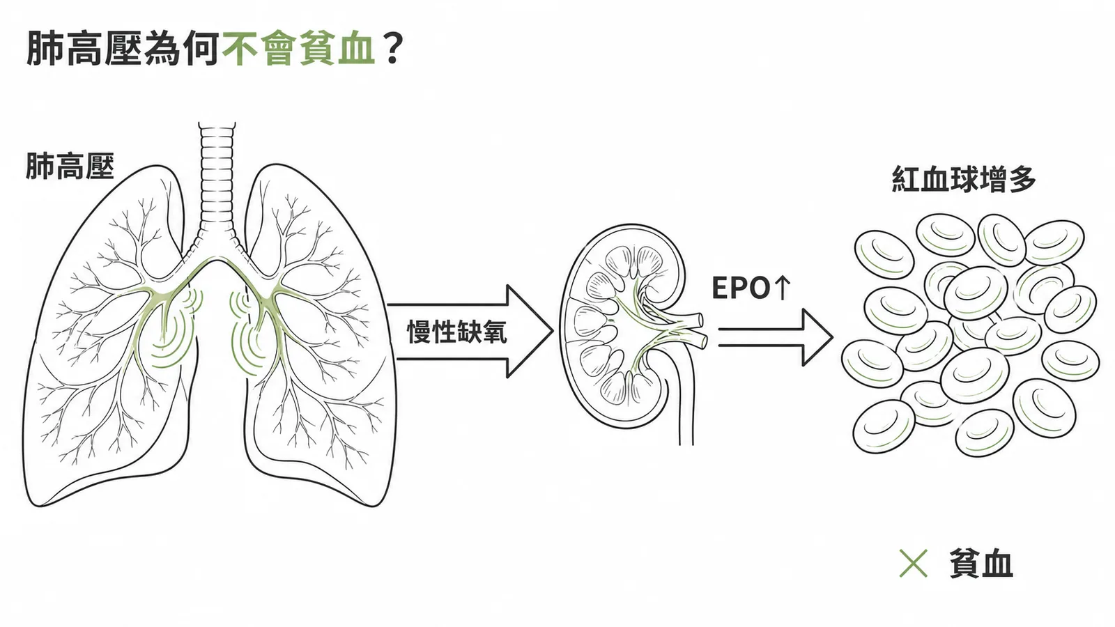 肺高壓導致慢性缺氧刺激EPO分泌使紅血球增多而非貧血