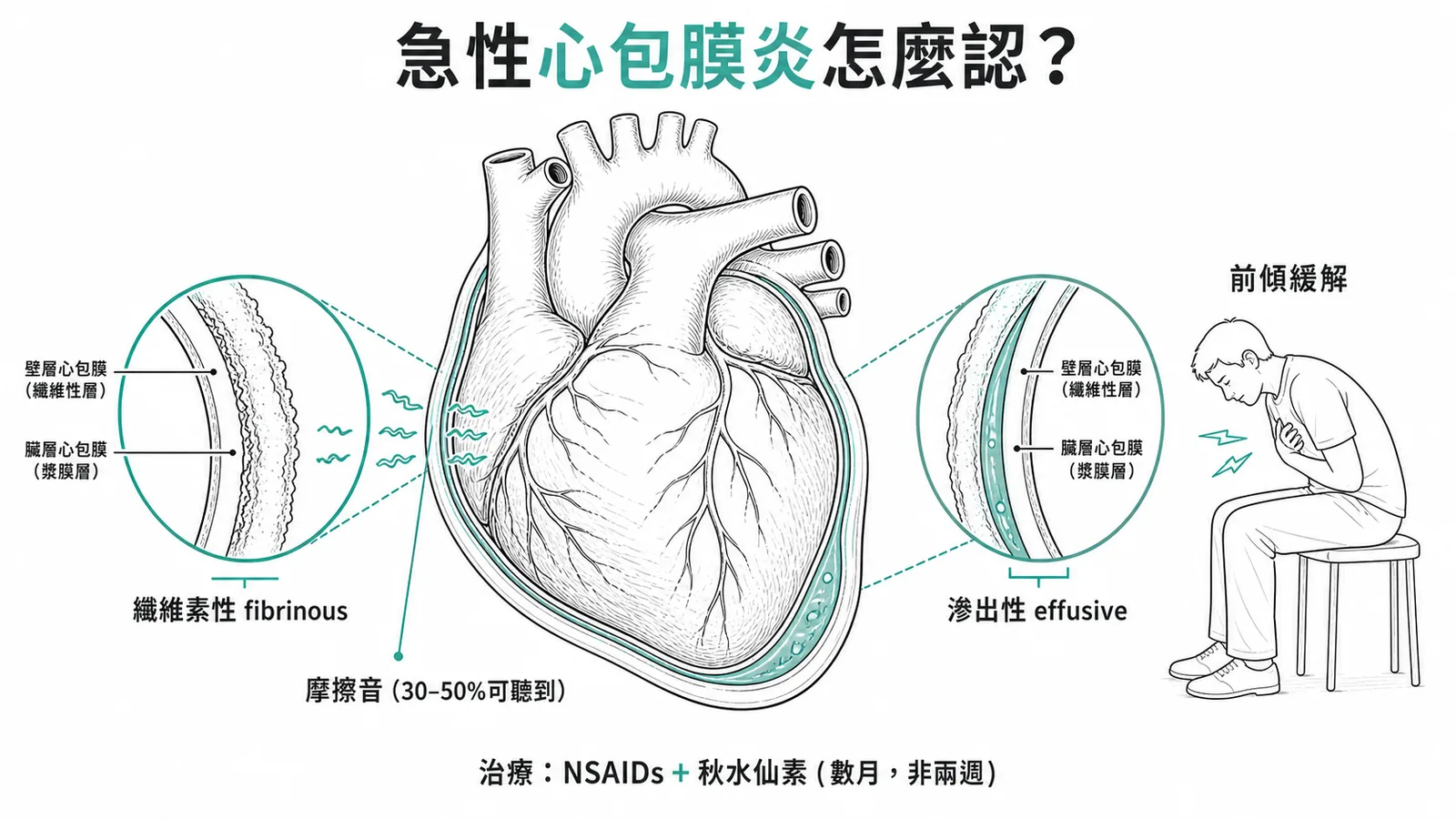急性心包膜炎特徵：纖維素性與滲出性分類、摩擦音、前傾緩解胸痛