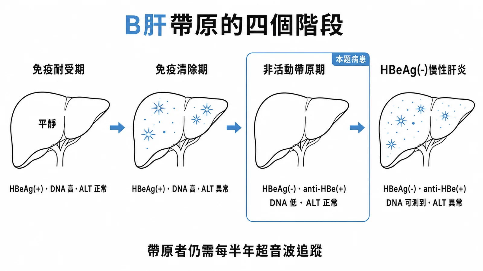 B型肝炎帶原四階段：免疫耐受期到HBeAg陰性慢性肝炎的自然病程
