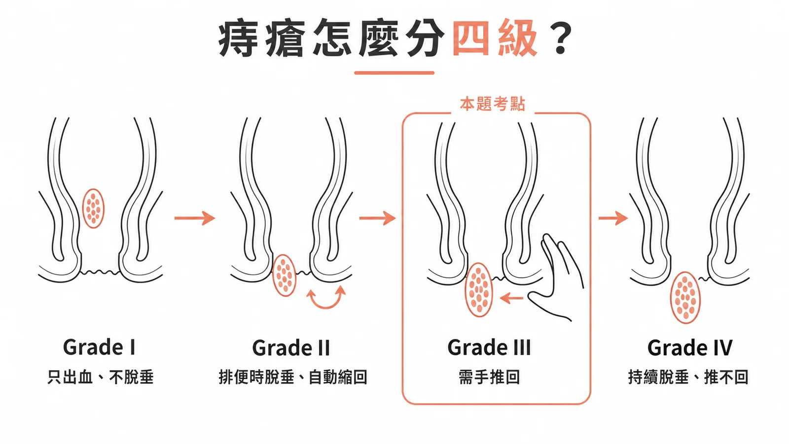 痔瘡Goligher四級分類：從不脫垂到持續脫垂推不回