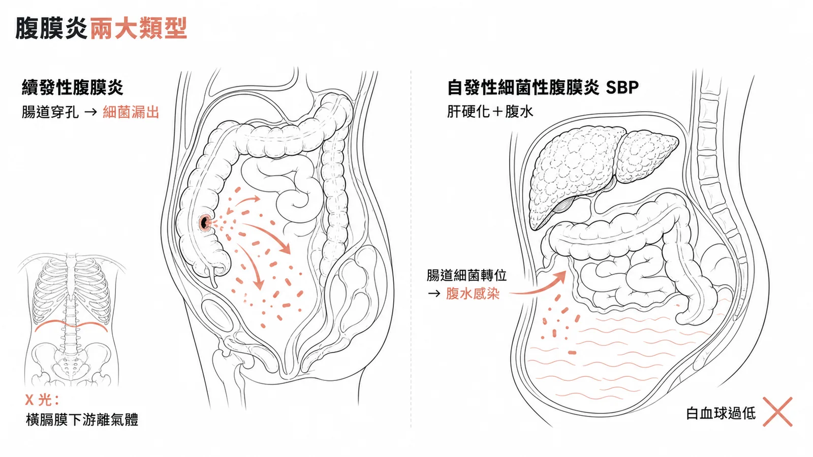 續發性腹膜炎與自發性細菌性腹膜炎SBP的病因對照
