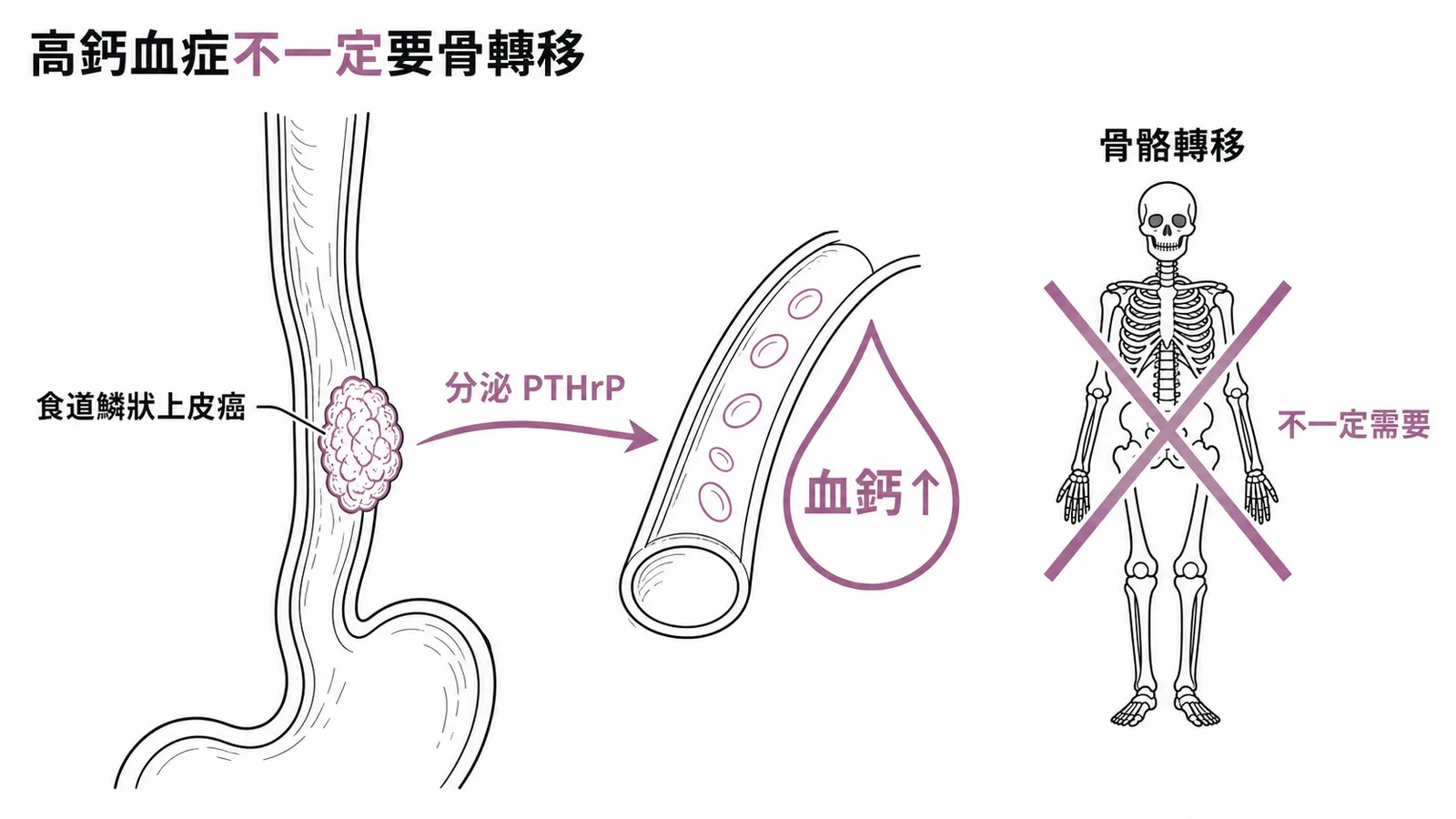 惡性腫瘤分泌PTHrP引起高鈣血症，不一定需要骨骼轉移