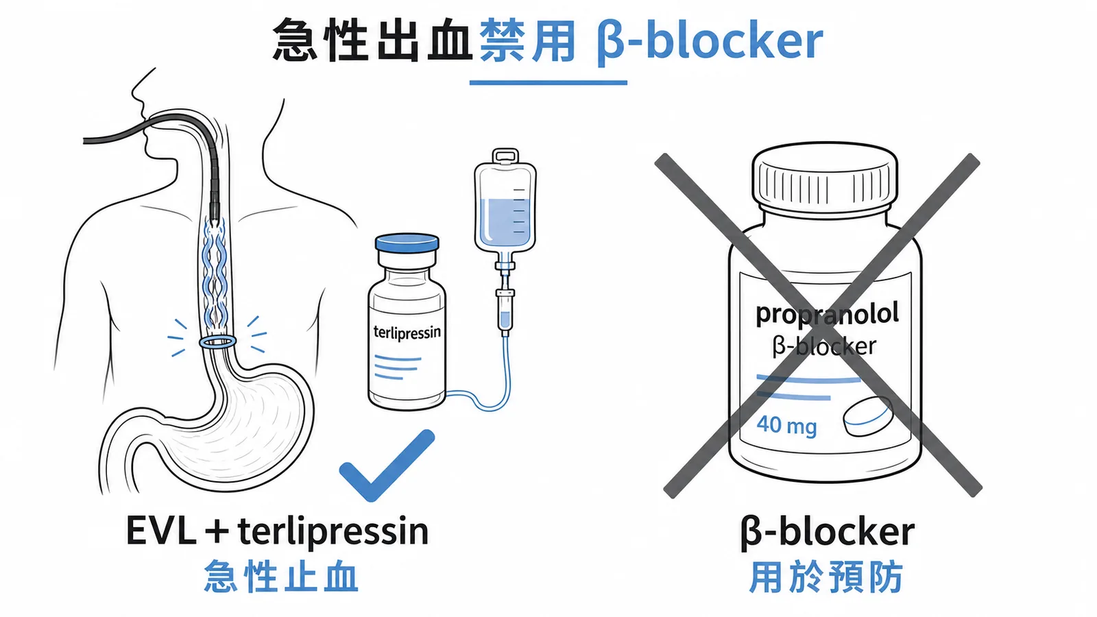 食道靜脈瘤急性出血用EVL與terlipressin止血，β-blocker僅用於預防期