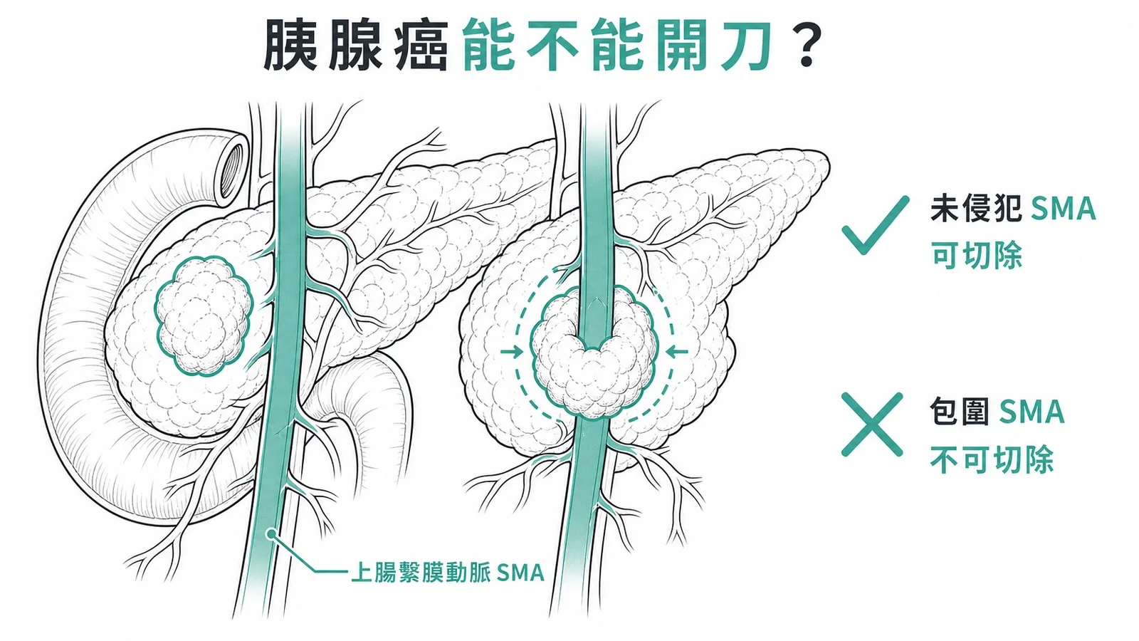 胰腺癌可切除性取決於是否侵犯上腸繫膜動脈SMA