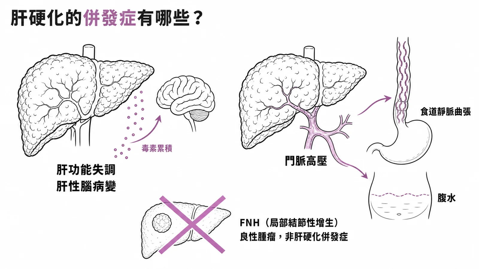 肝硬化兩大類併發症與FNH無關的對照