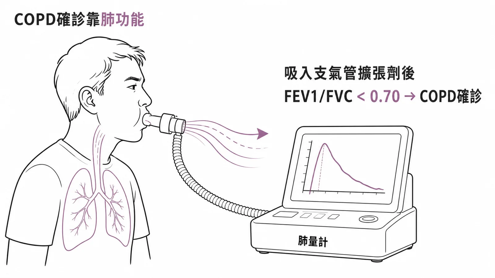 COPD診斷黃金標準肺功能檢查支氣管擴張試驗FEV1FVC小於0.70示意圖
