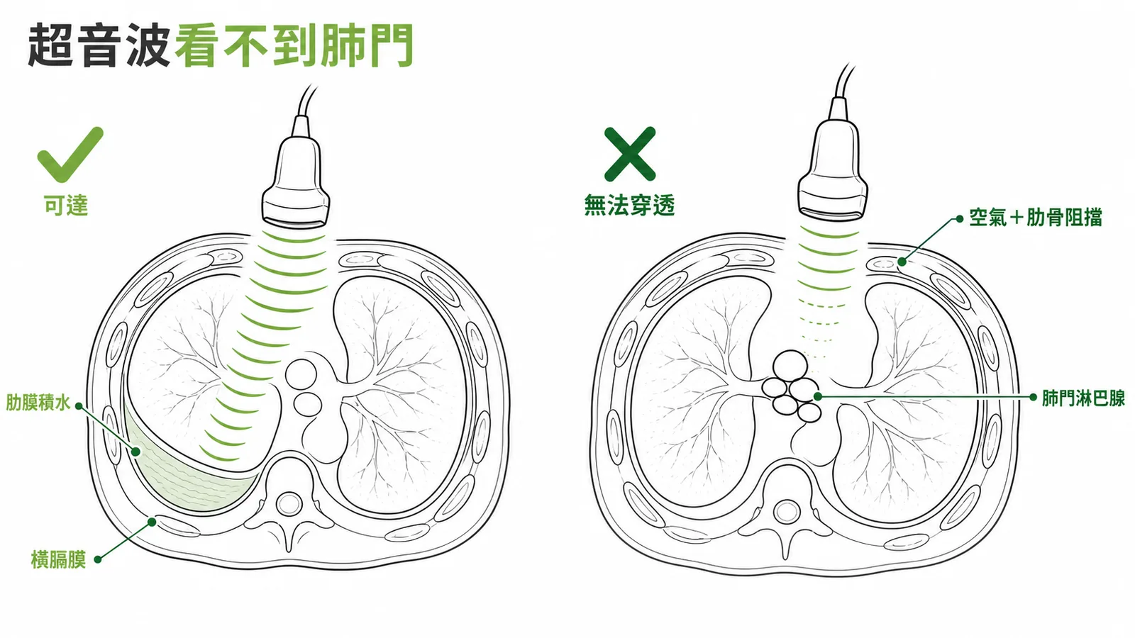 胸腔超音波可達肋膜積水與橫膈膜但無法穿透到深處肺門淋巴腺示意圖