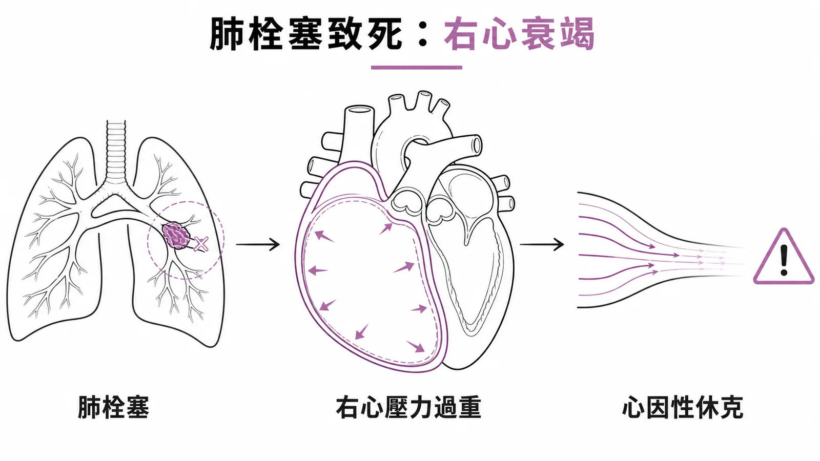 嚴重肺栓塞致死機轉為右心室壓力過重導致心因性休克