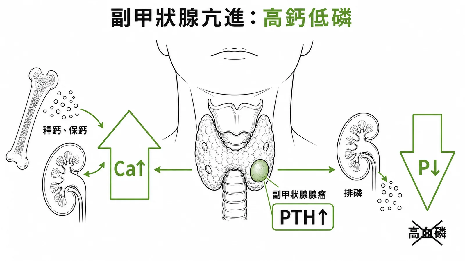 原發性副甲狀腺機能亢進的核心特徵為高血鈣低血磷