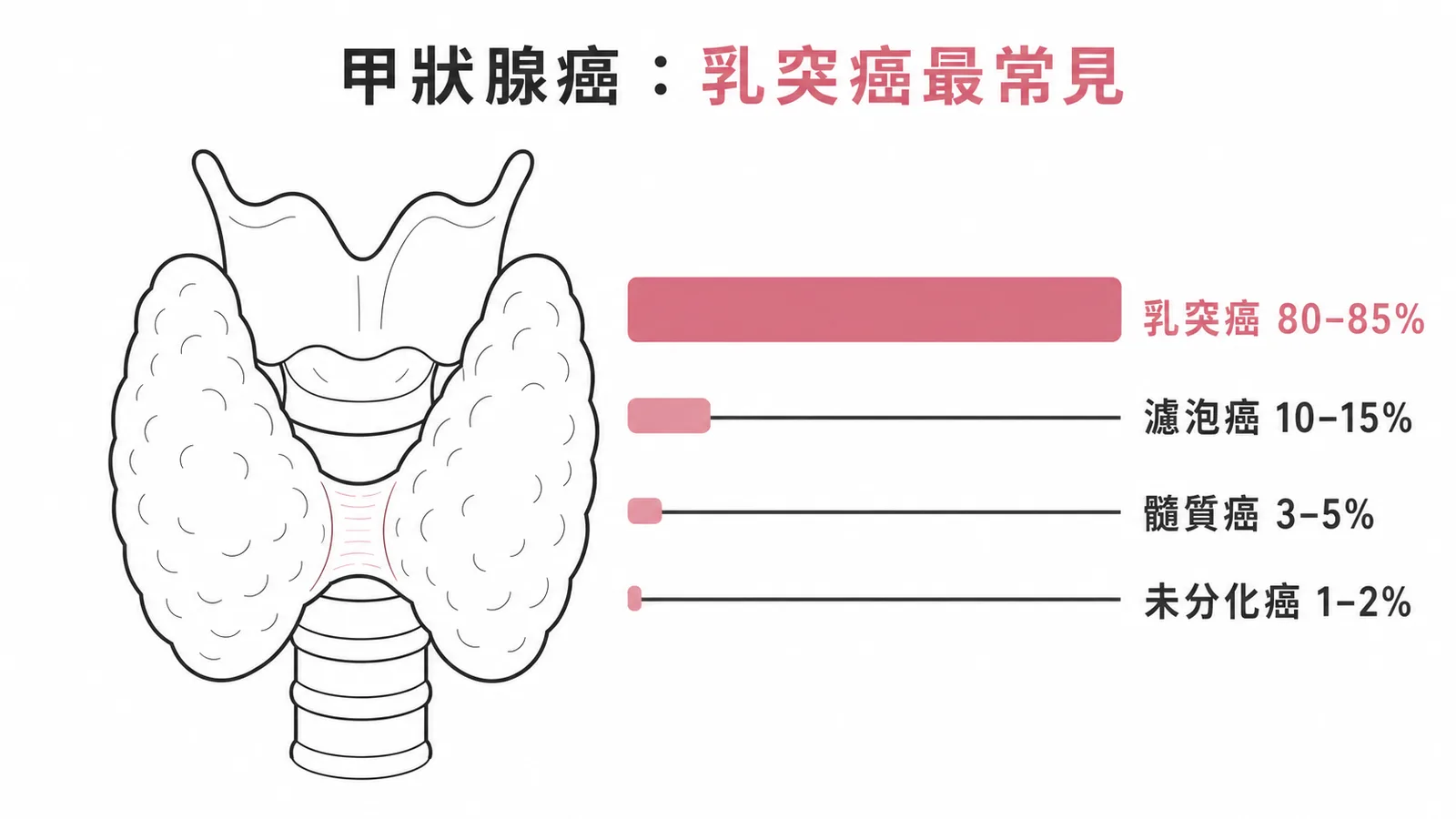 甲狀腺癌類型比例乳突癌佔80至85%最常見