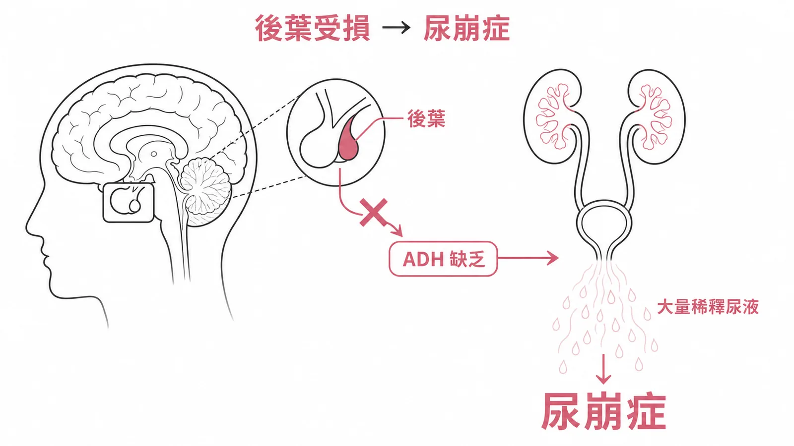 腦下垂體後葉受損導致ADH缺乏引發尿崩症