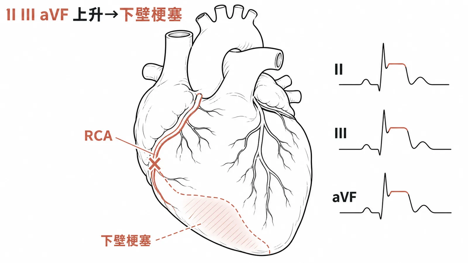 急性下壁心肌梗塞——RCA阻塞導致Lead II III aVF的ST波段上升