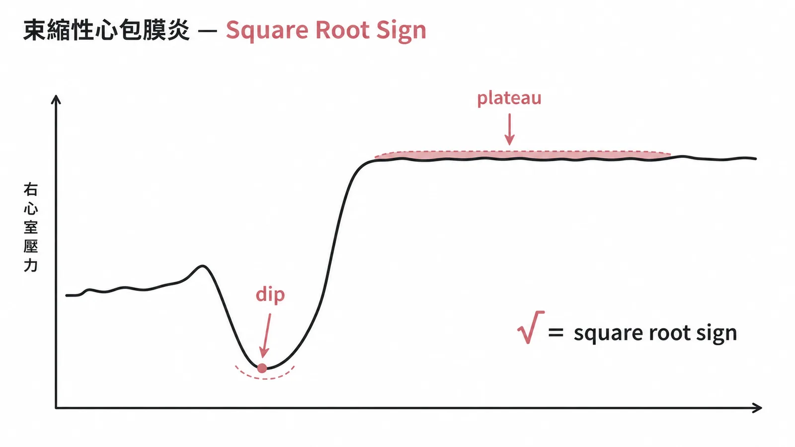 束縮性心包膜炎右心室壓力曲線呈dip and plateau即square root sign